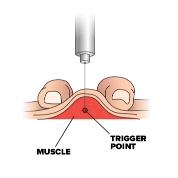 dry needling diagram